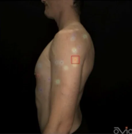 Side view of patient undergoing mole detection